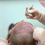 Understanding The Unique Hair Characteristics of African-American Hair For Hair Transplantation