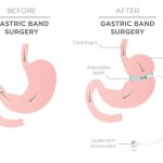 5 Surprising Benefits of Adjustable Gastric Balloon For Weight Loss